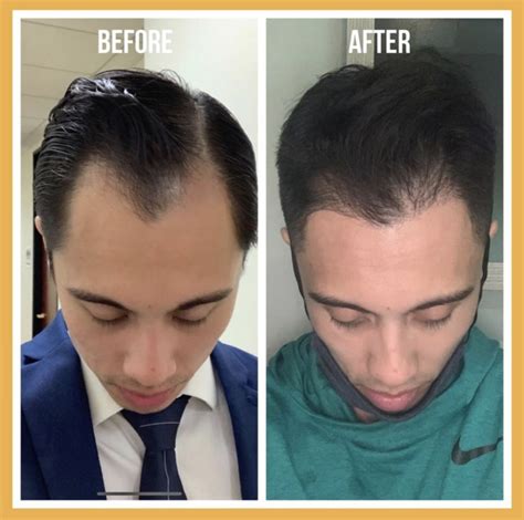Transform your thinning hairline with Magic Ezy Hairline Restoration.
